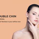 Double chin liposuction in Dubai