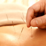 Acupuncture Myths