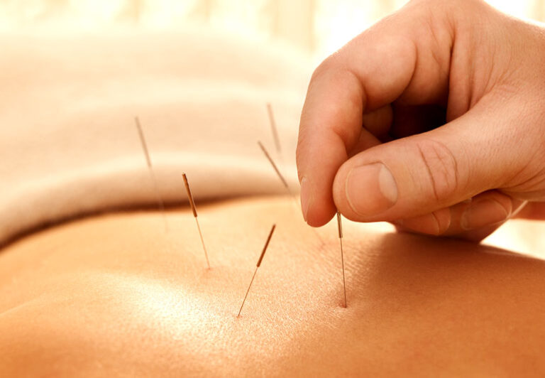 Acupuncture Myths